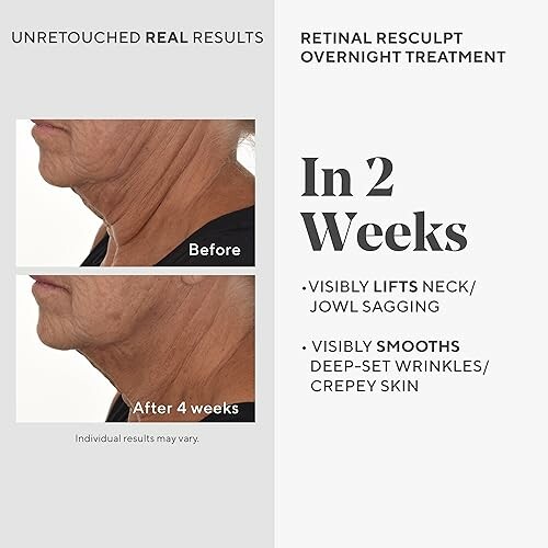 Before and after results of retinol treatment on neck wrinkles.