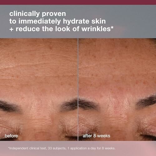 Comparison of skin before and after 8 weeks of treatment showing reduced wrinkles.